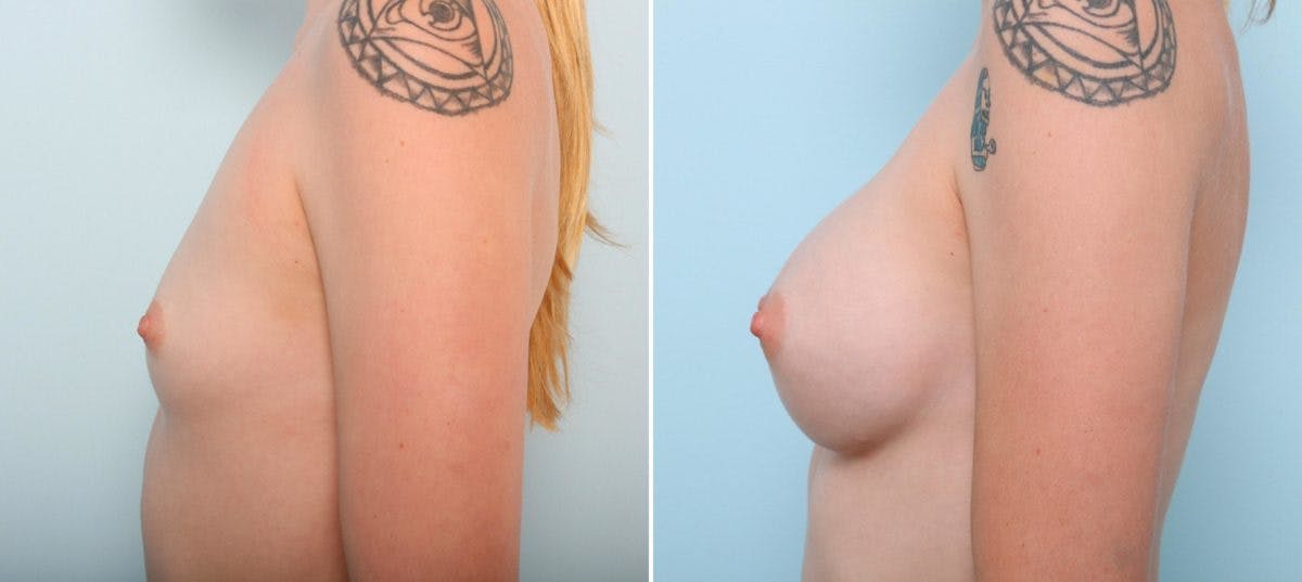 Breast Augmentation Before & After Gallery - Patient 54887094 - Image 5