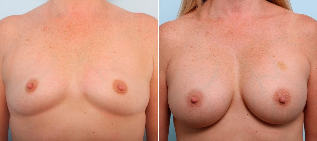 Breast Augmentation Before & After Photo - Patient 54887106 - Image 1