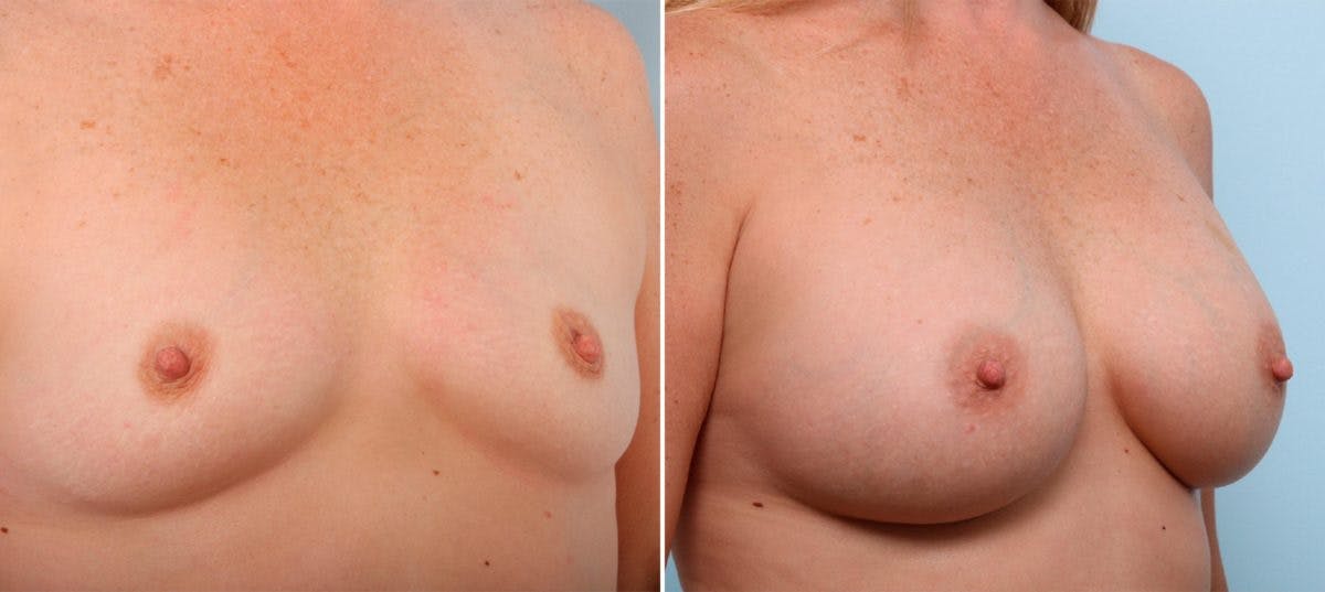 Breast Augmentation Before & After Gallery - Patient 54887106 - Image 2