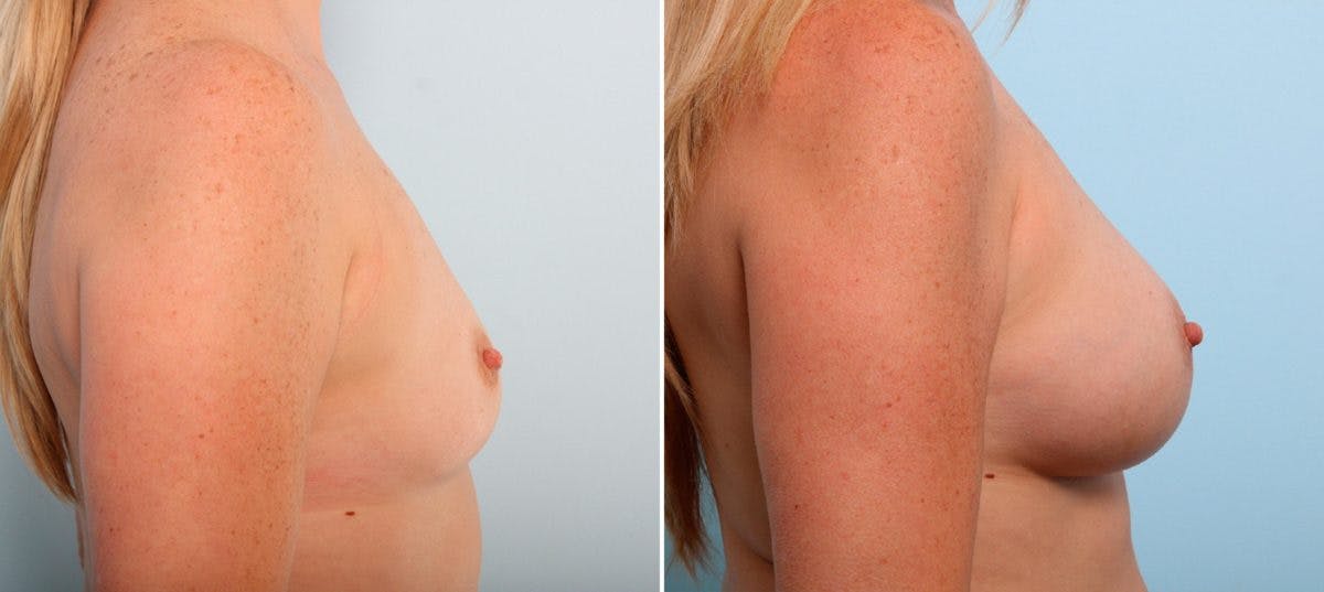 Breast Augmentation Before & After Gallery - Patient 54887106 - Image 3