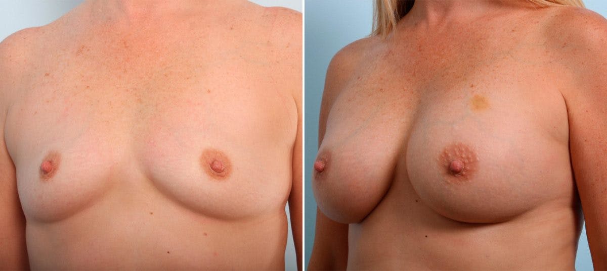 Breast Augmentation Before & After Gallery - Patient 54887106 - Image 4