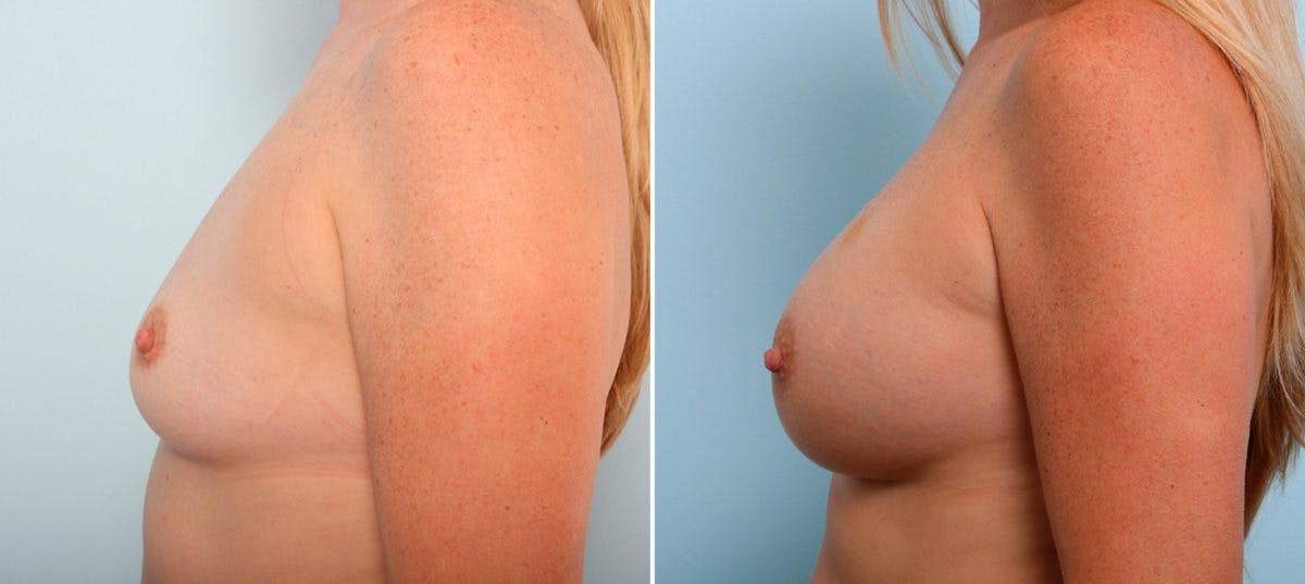 Breast Augmentation Before & After Gallery - Patient 54887106 - Image 5