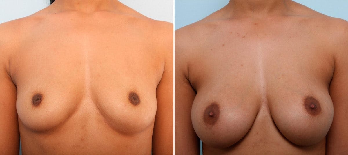 Breast Augmentation Before & After Gallery - Patient 54887119 - Image 1