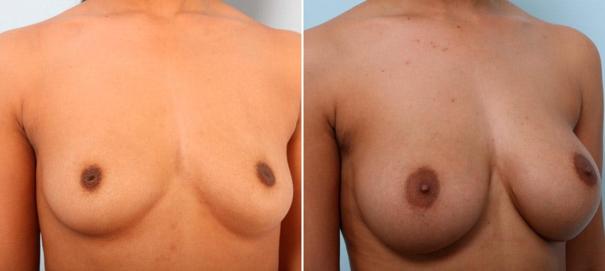 Breast Augmentation Before & After Gallery - Patient 54887119 - Image 2