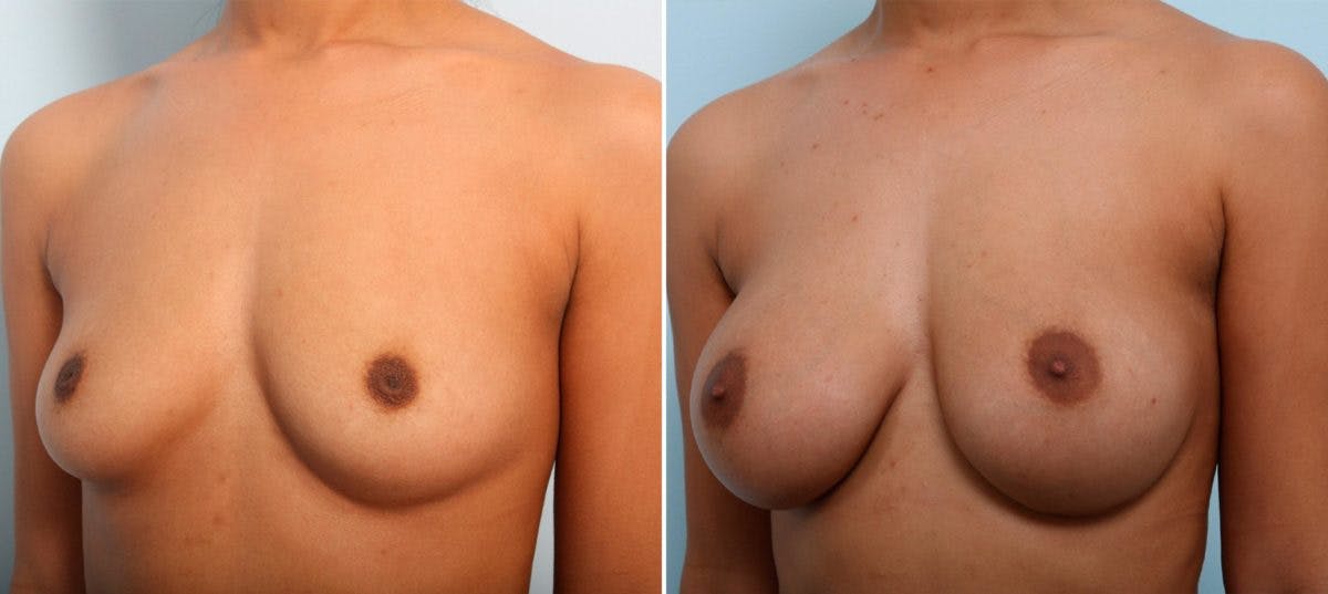 Breast Augmentation Before & After Gallery - Patient 54887119 - Image 4