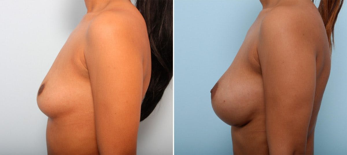 Breast Augmentation Before & After Gallery - Patient 54887119 - Image 5