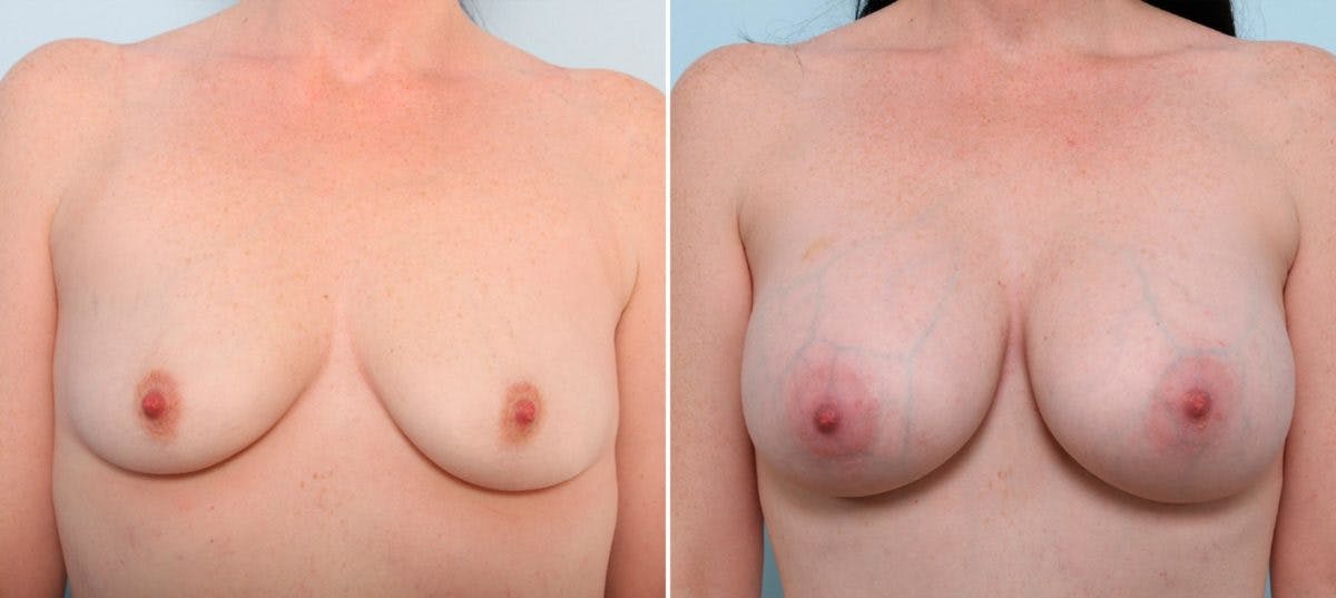 Breast Augmentation Before & After Gallery - Patient 54887127 - Image 1