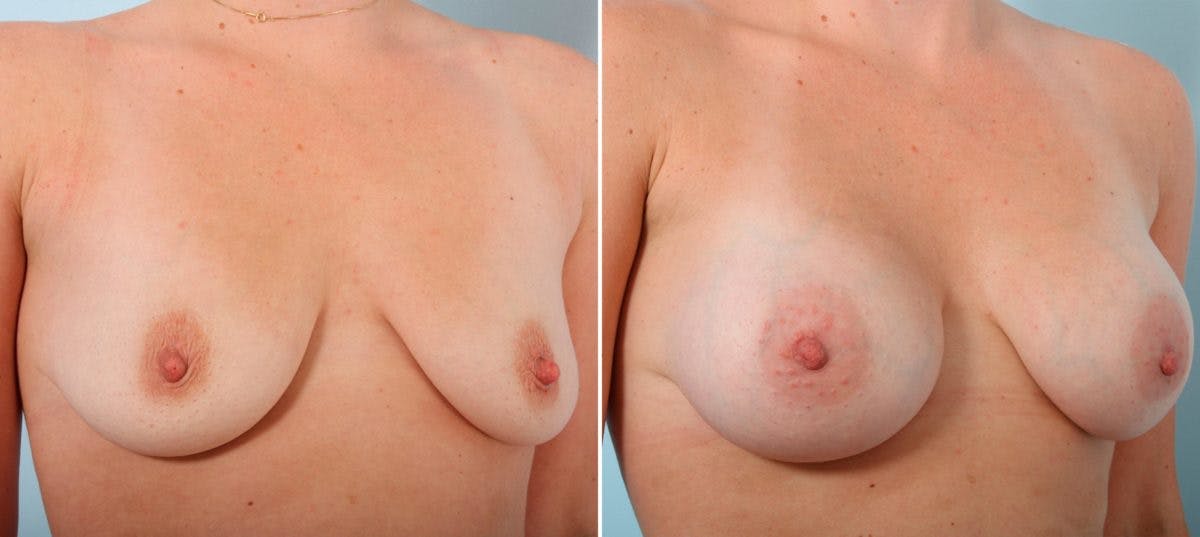 Breast Augmentation Before & After Gallery - Patient 54887135 - Image 2