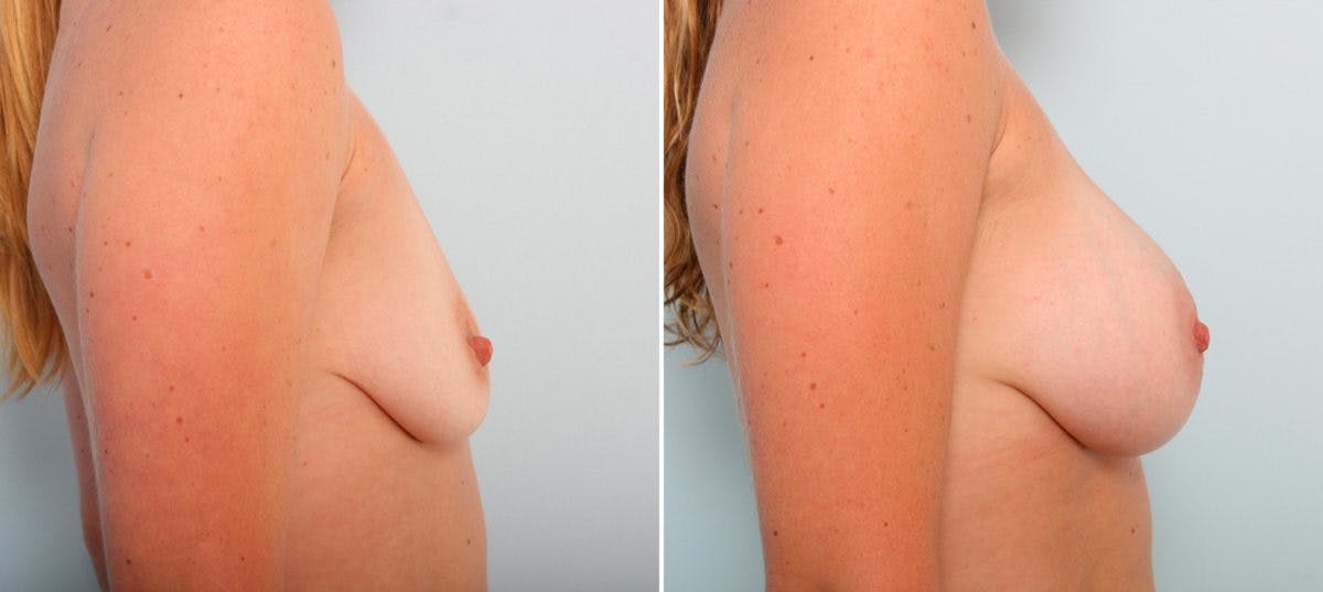 Breast Augmentation Before & After Gallery - Patient 54887135 - Image 3