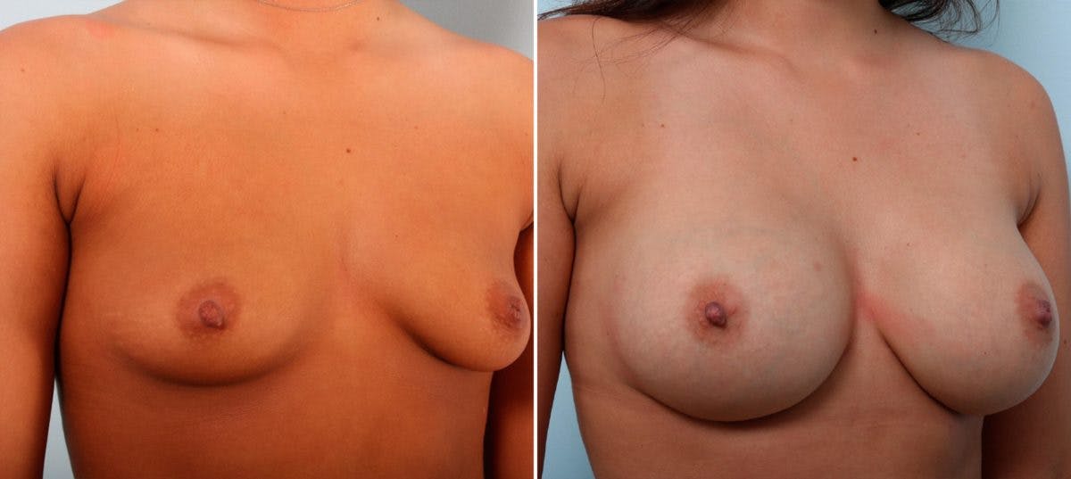 Breast Augmentation Before & After Gallery - Patient 54887139 - Image 2