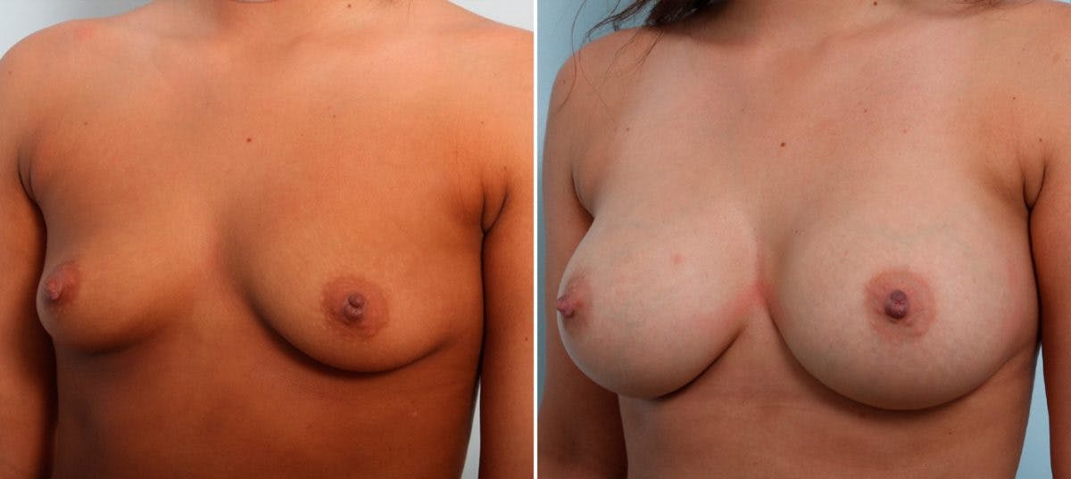 Breast Augmentation Before & After Gallery - Patient 54887139 - Image 4