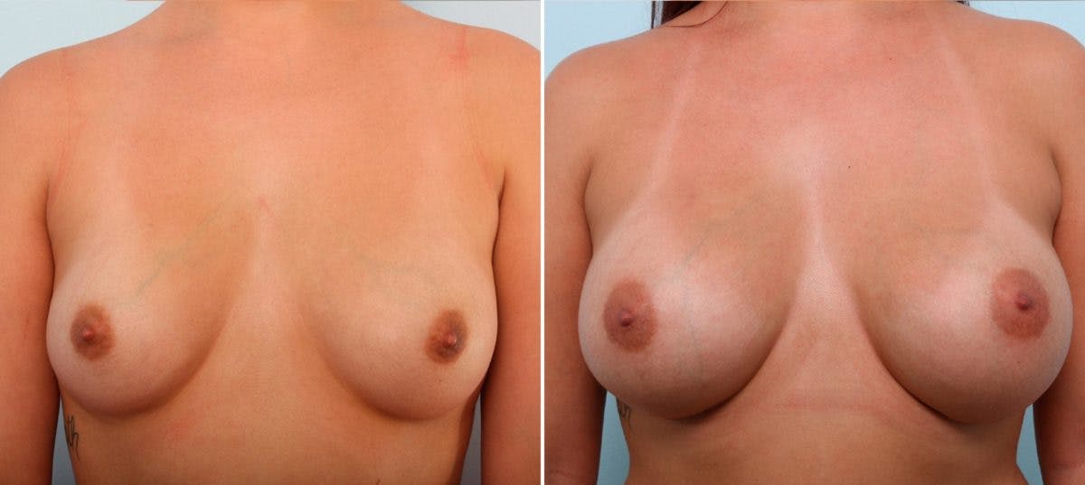 Breast Augmentation Before & After Gallery - Patient 54887151 - Image 1