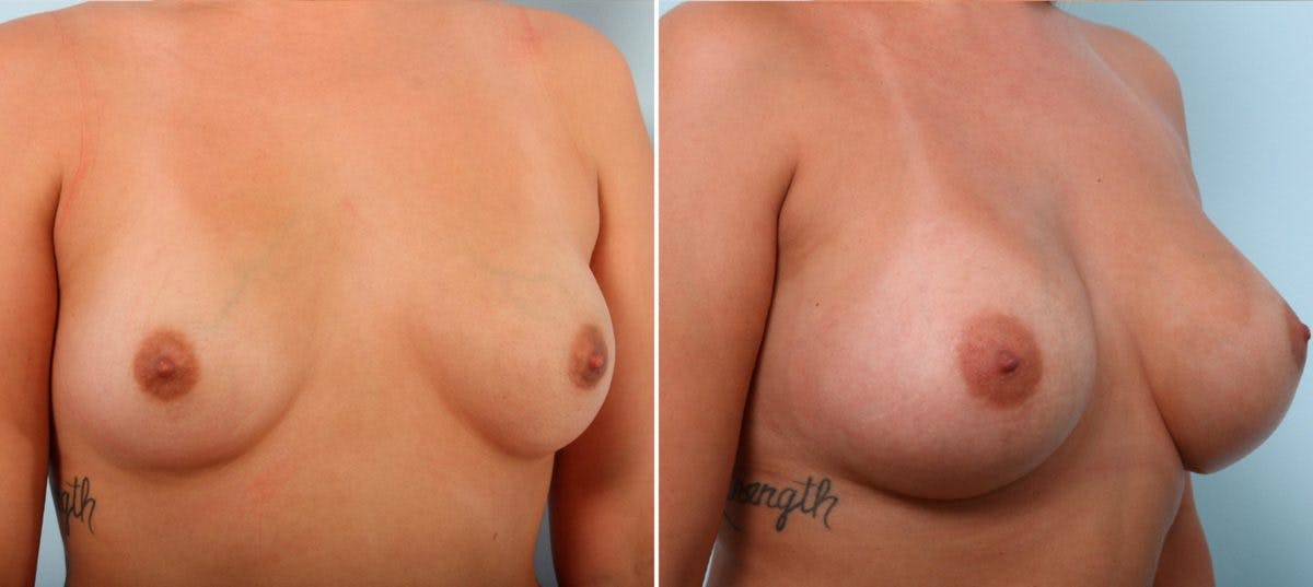Breast Augmentation Before & After Gallery - Patient 54887151 - Image 2