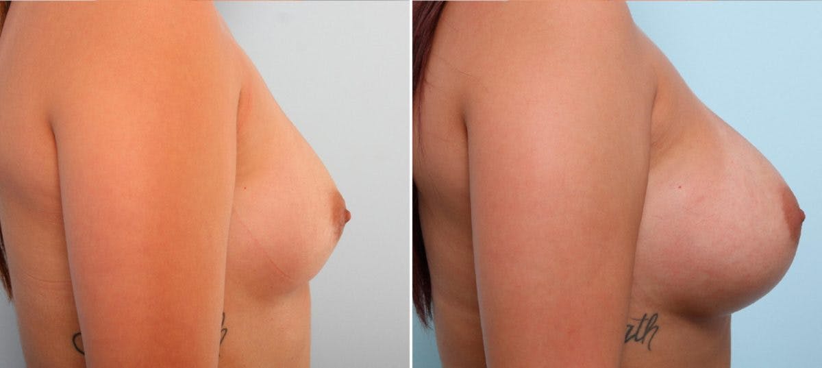 Breast Augmentation Before & After Gallery - Patient 54887151 - Image 3