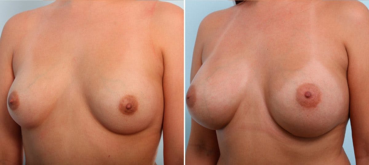 Breast Augmentation Before & After Gallery - Patient 54887151 - Image 4