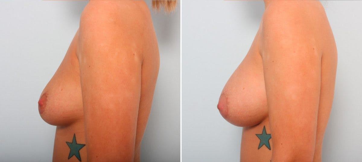 Breast Augmentation Before & After Gallery - Patient 54887168 - Image 5
