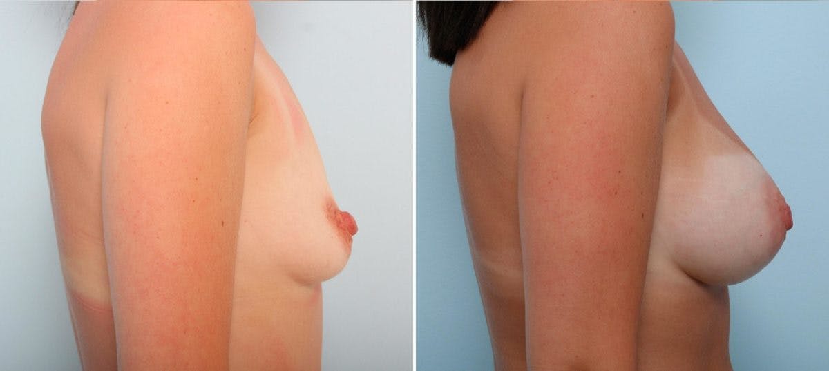 Breast Augmentation Before & After Gallery - Patient 54887190 - Image 3