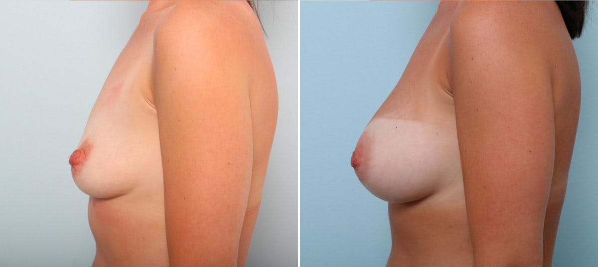Breast Augmentation Before & After Gallery - Patient 54887190 - Image 5