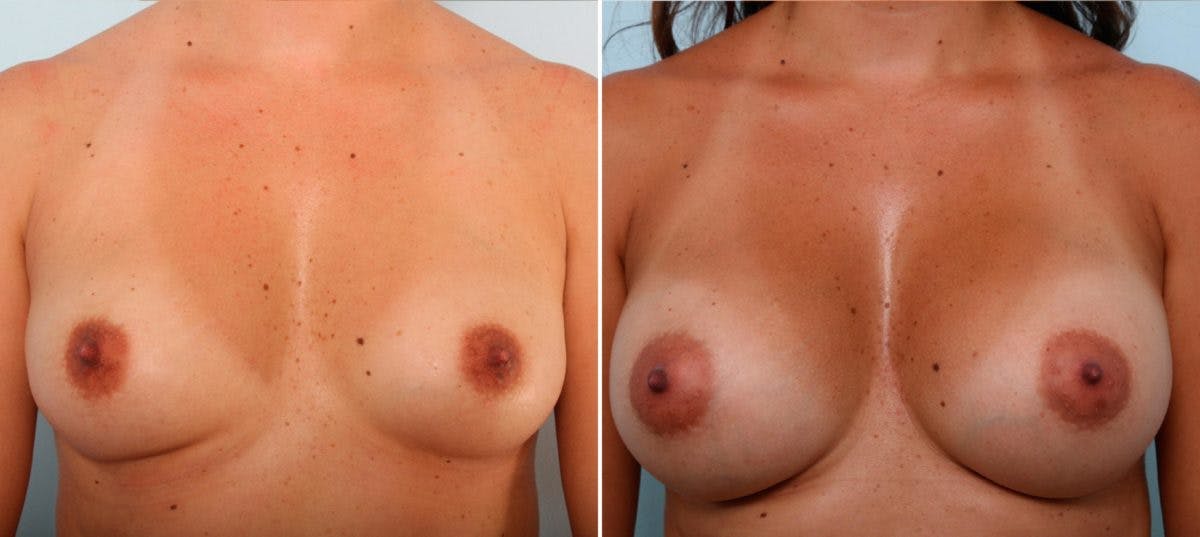 Breast Augmentation Before & After Photo - Patient 54887200 - Image 1