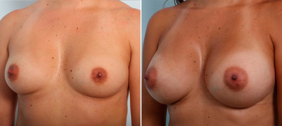 Breast Augmentation Before & After Gallery - Patient 54887200 - Image 4