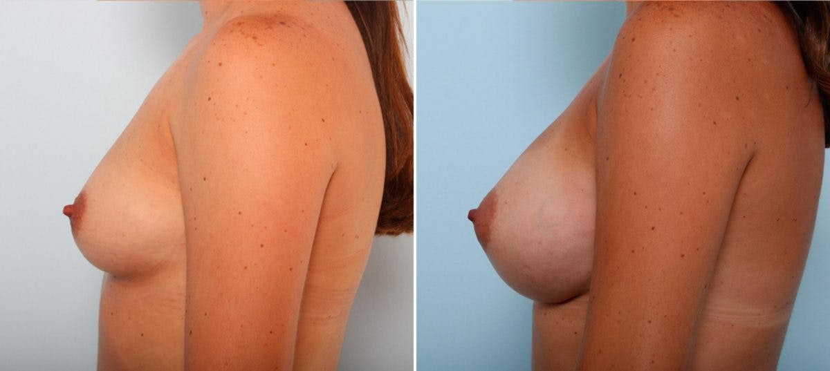 Breast Augmentation Before & After Photo - Patient 54887200 - Image 5