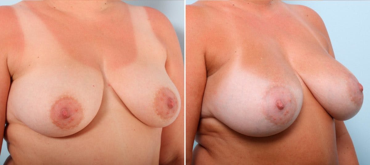 Breast Augmentation Before & After Gallery - Patient 54887212 - Image 2