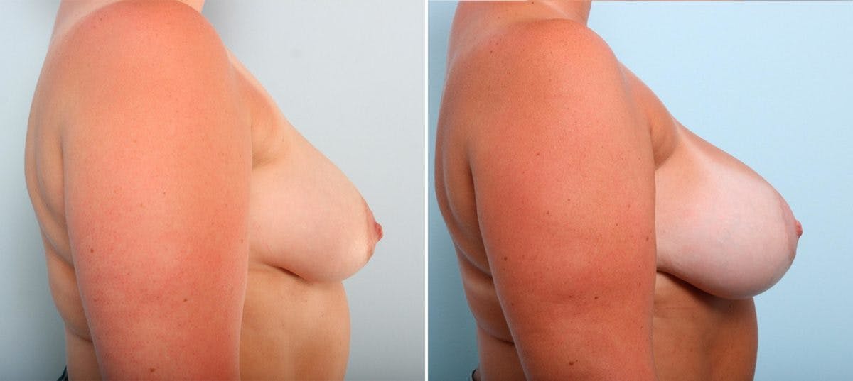 Breast Augmentation Before & After Gallery - Patient 54887212 - Image 3