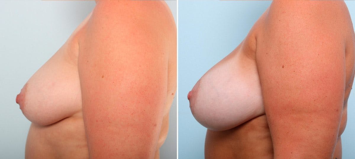 Breast Augmentation Before & After Gallery - Patient 54887212 - Image 5