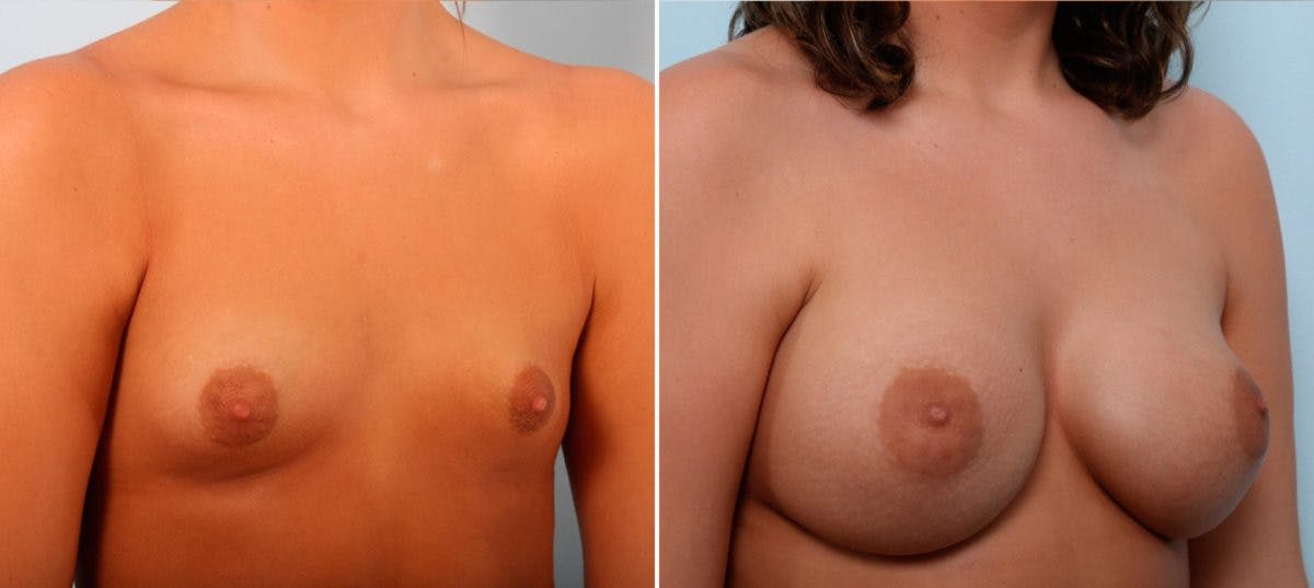 Breast Augmentation Before & After Gallery - Patient 54887225 - Image 2