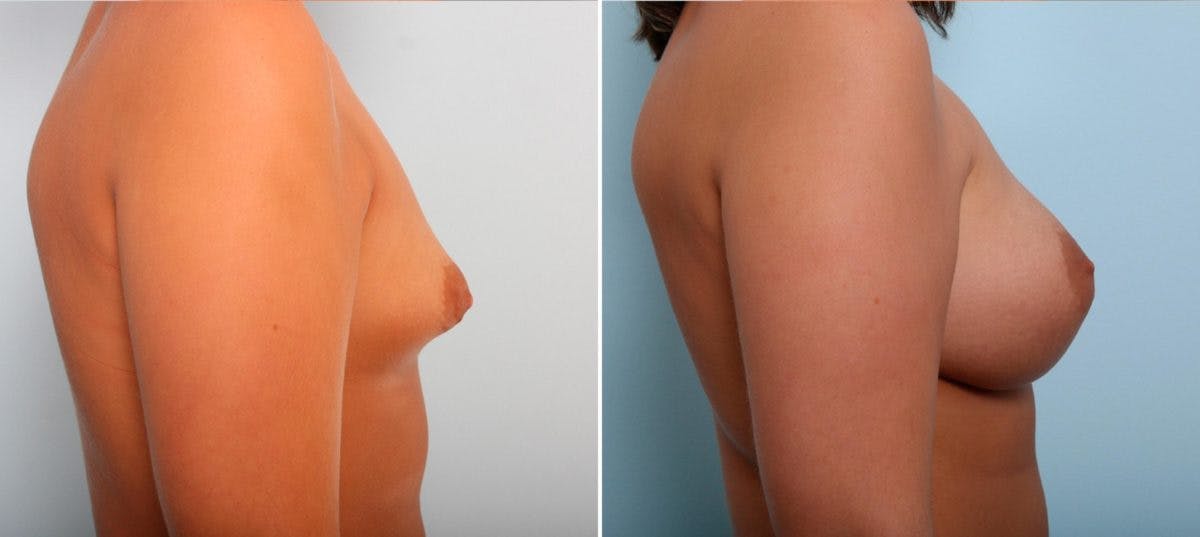 Breast Augmentation Before & After Gallery - Patient 54887225 - Image 3