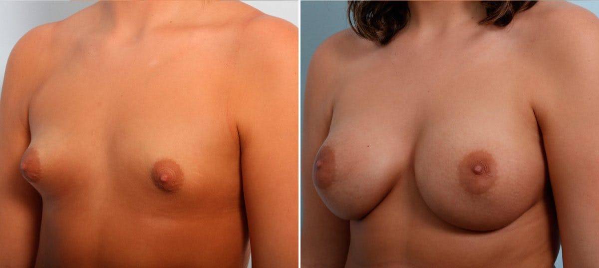 Breast Augmentation Before & After Gallery - Patient 54887225 - Image 4