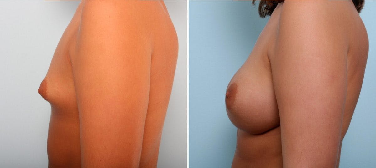 Breast Augmentation Before & After Gallery - Patient 54887225 - Image 5