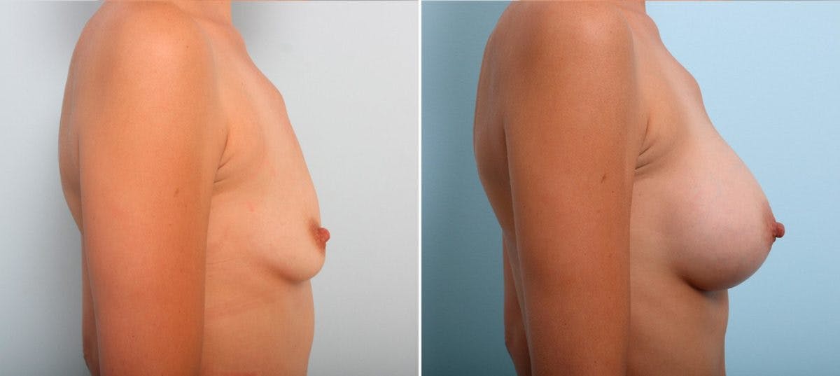 Breast Augmentation Before & After Photo - Patient 54887226 - Image 3