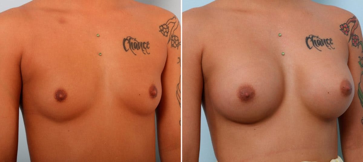 Breast Augmentation Before & After Photo - Patient 54887227 - Image 2