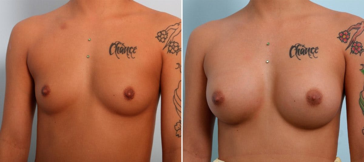 Breast Augmentation Before & After Gallery - Patient 54887227 - Image 4