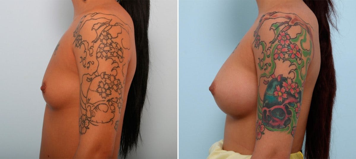 Breast Augmentation Before & After Photo - Patient 54887227 - Image 5
