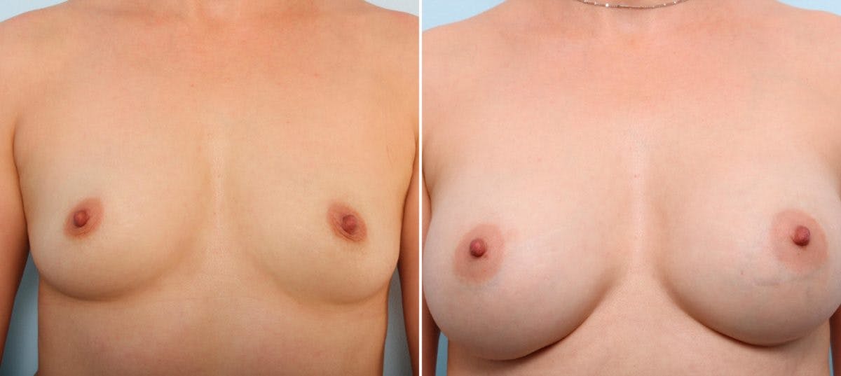 Breast Augmentation Before & After Gallery - Patient 54887228 - Image 1