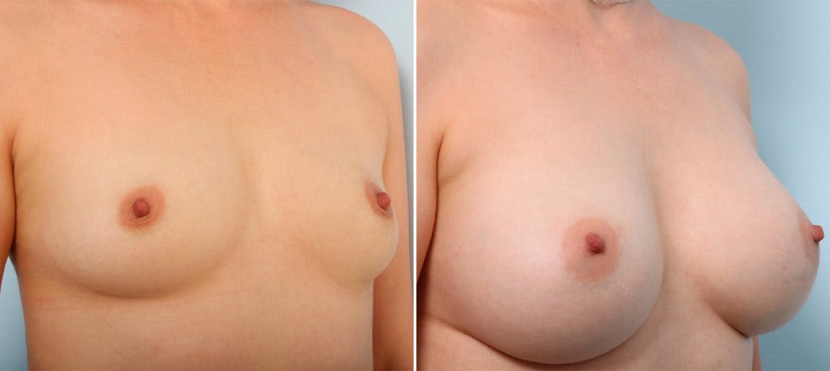 Breast Augmentation Before & After Gallery - Patient 54887228 - Image 2
