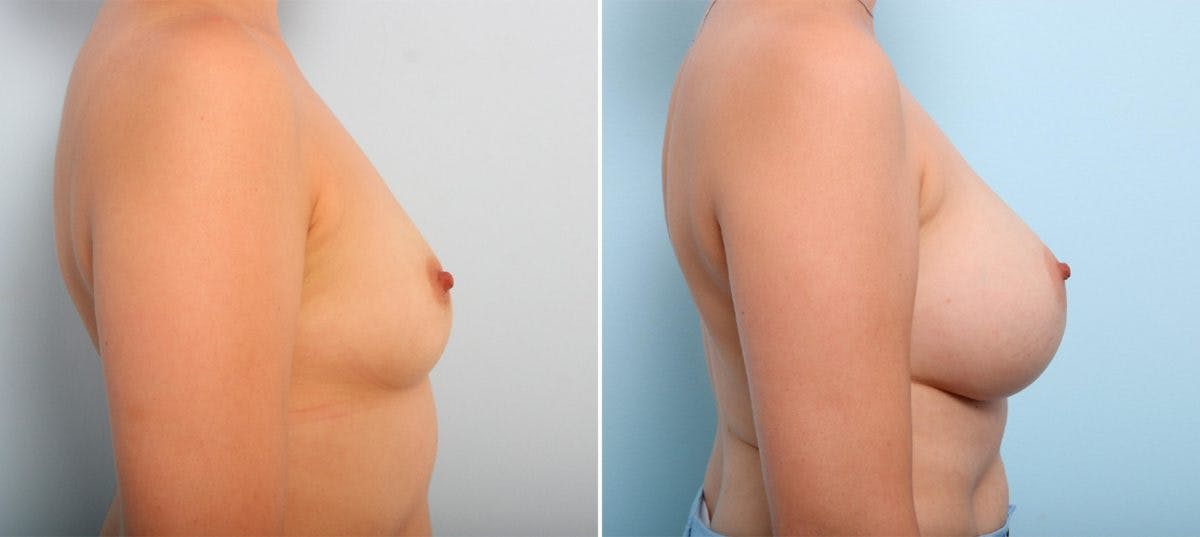 Breast Augmentation Before & After Gallery - Patient 54887228 - Image 3