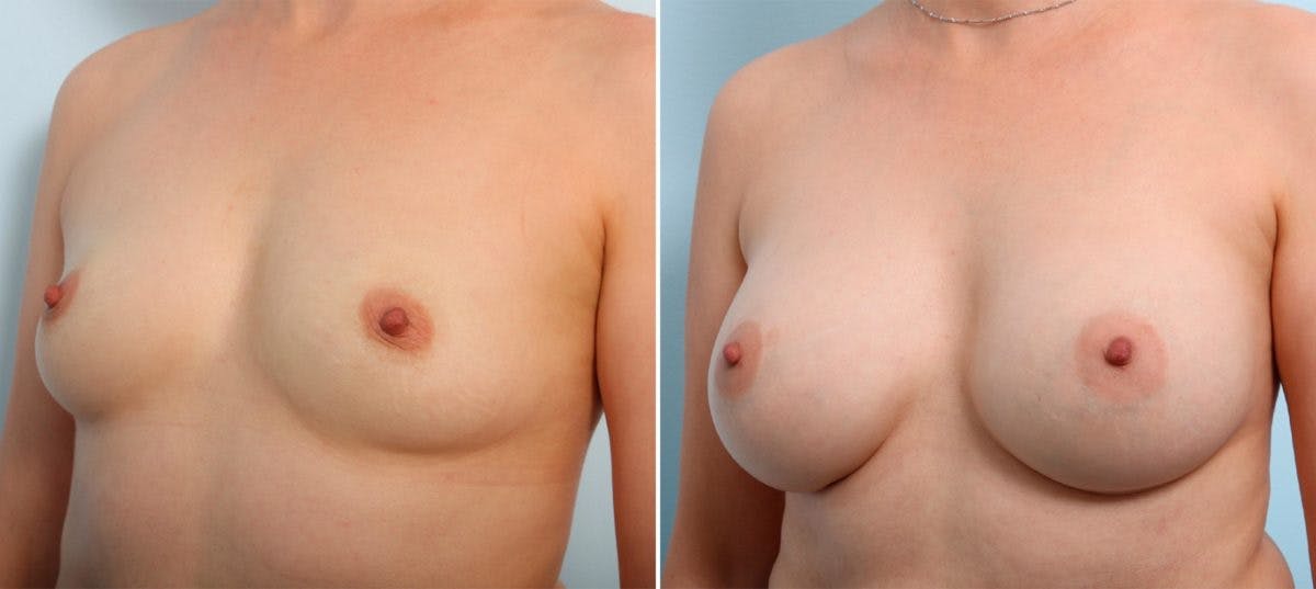 Breast Augmentation Before & After Gallery - Patient 54887228 - Image 4