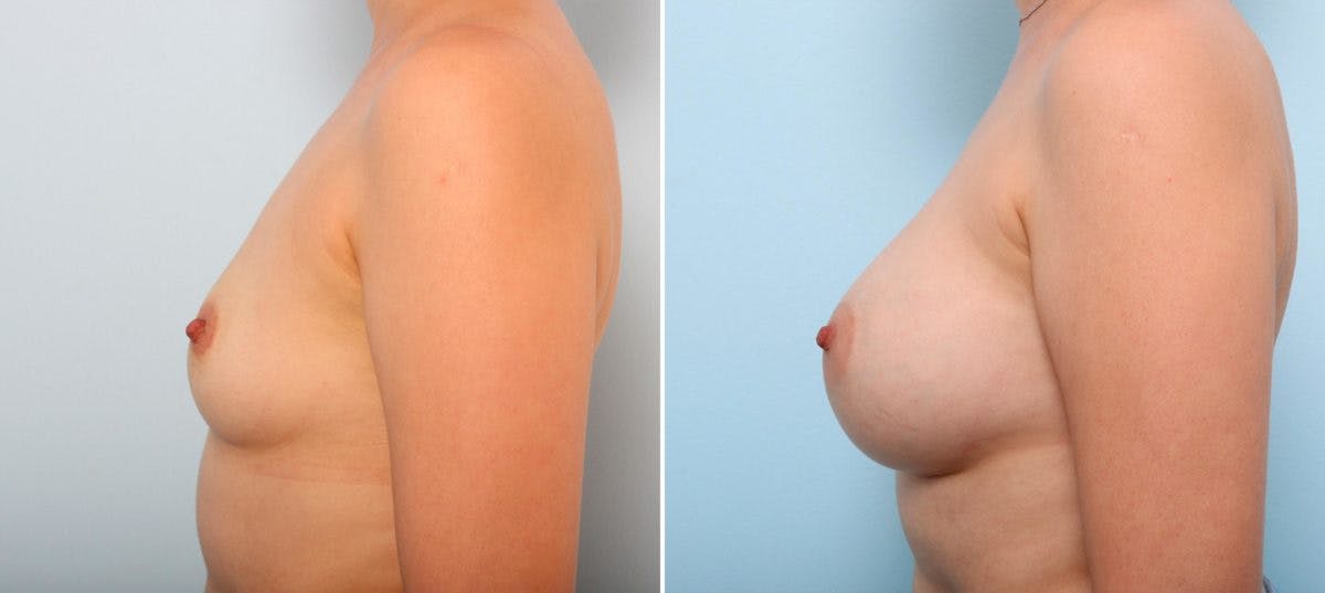 Breast Augmentation Before & After Gallery - Patient 54887228 - Image 5