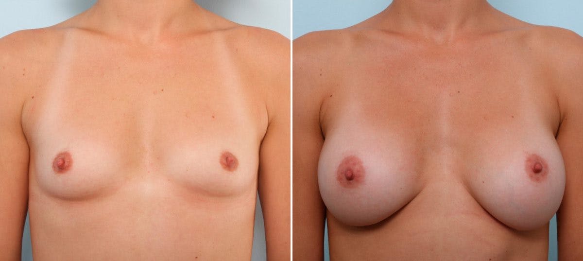 Breast Augmentation Before & After Gallery - Patient 54887230 - Image 1