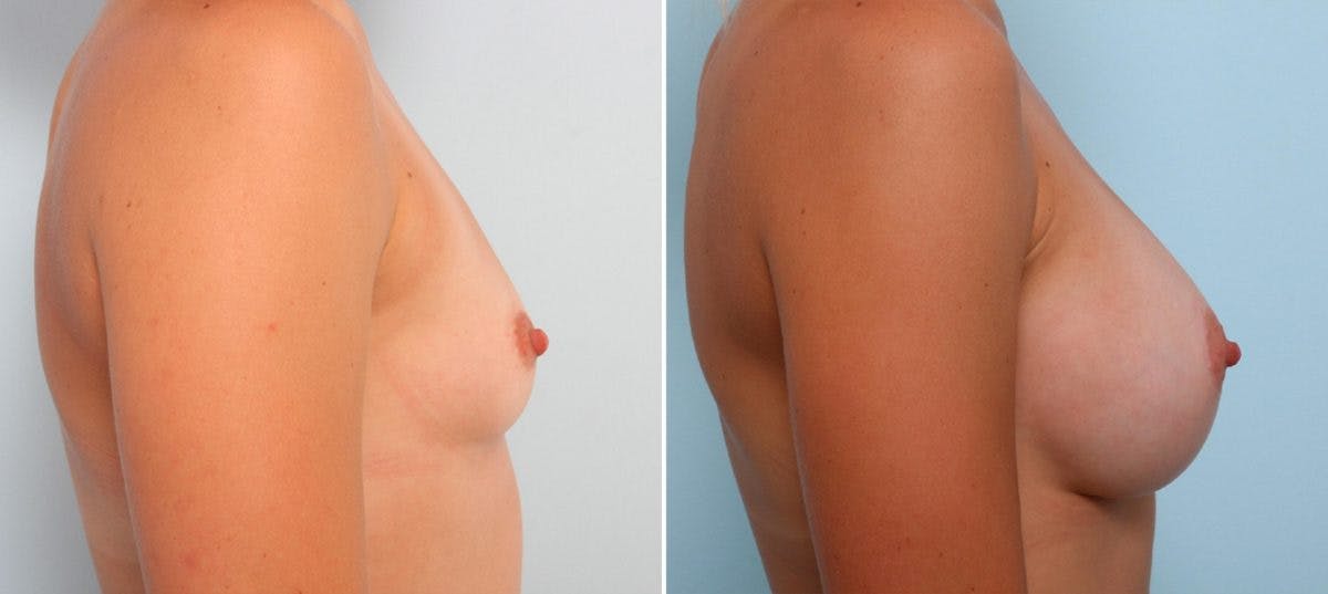 Breast Augmentation Before & After Gallery - Patient 54887230 - Image 3