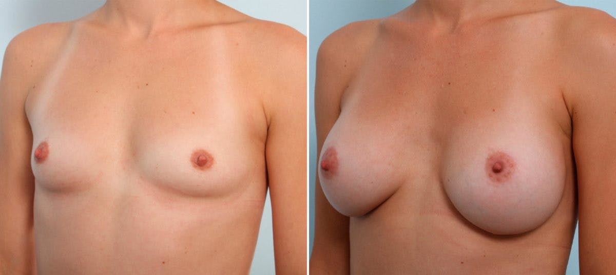 Breast Augmentation Before & After Gallery - Patient 54887230 - Image 4