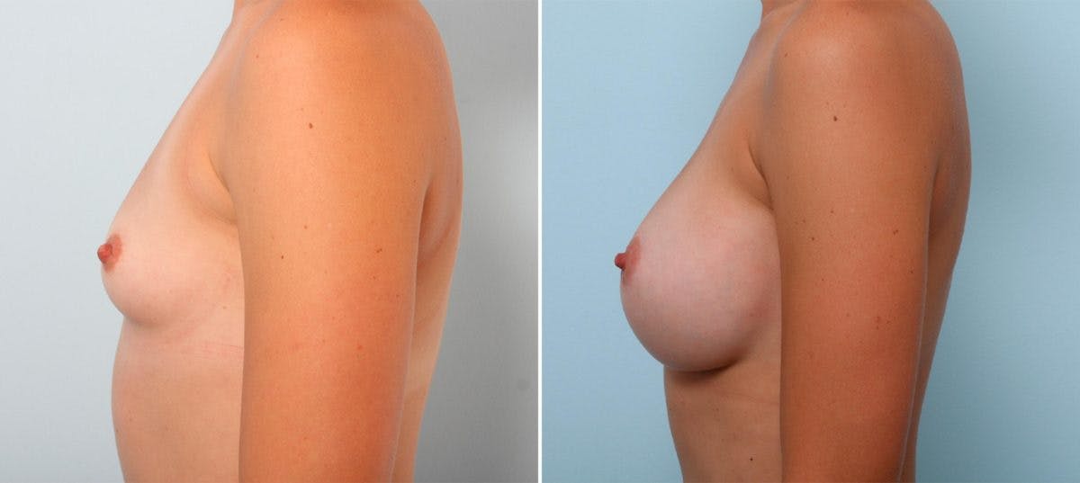 Breast Augmentation Before & After Gallery - Patient 54887230 - Image 5