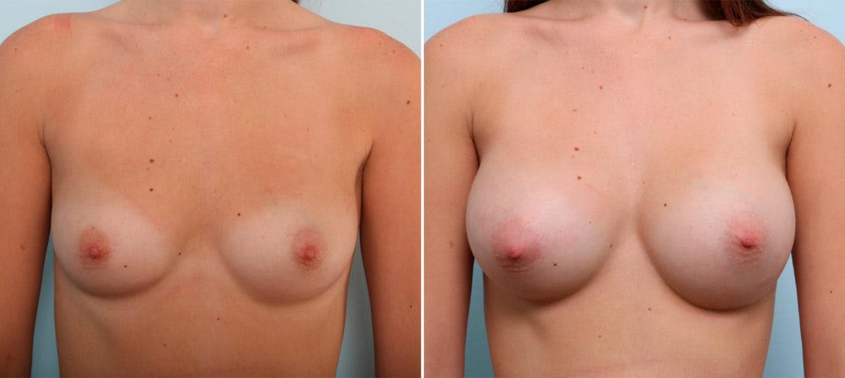 Breast Augmentation Before & After Gallery - Patient 54887231 - Image 1
