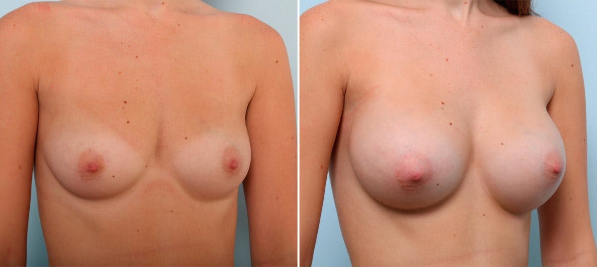 Breast Augmentation Before & After Gallery - Patient 54887231 - Image 2