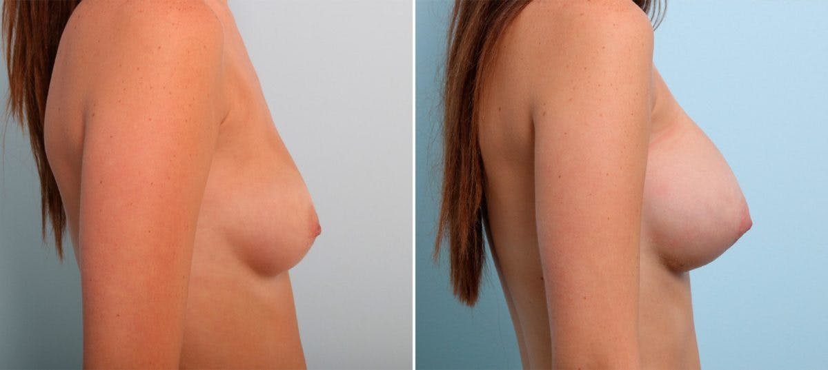 Breast Augmentation Before & After Gallery - Patient 54887231 - Image 3