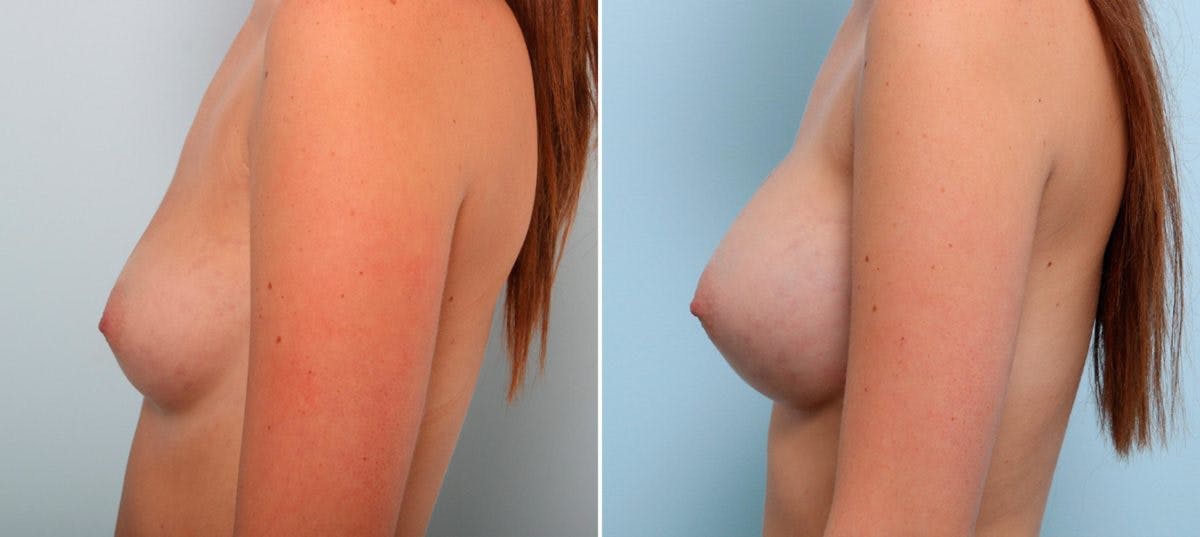 Breast Augmentation Before & After Gallery - Patient 54887231 - Image 5