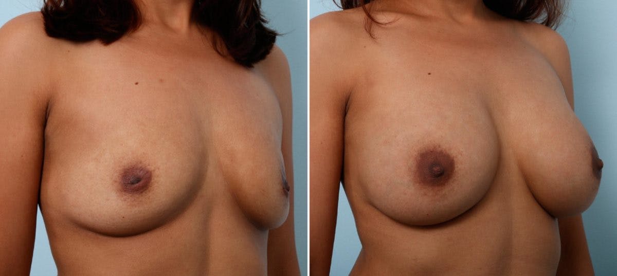 Breast Augmentation Before & After Gallery - Patient 54887232 - Image 2
